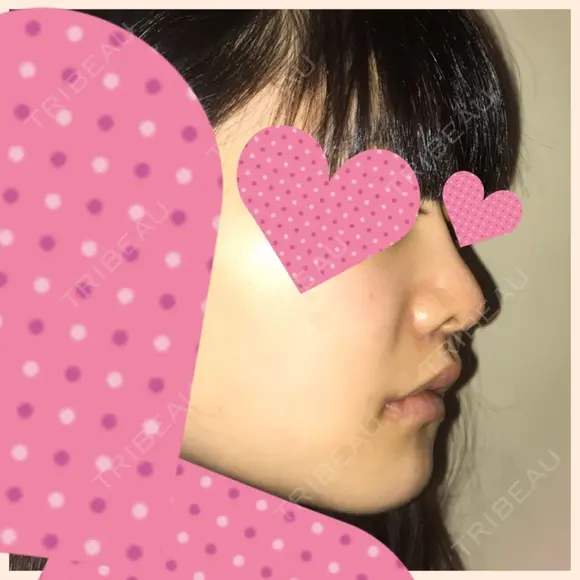 セットバック 大塚美容形成外科・歯科 大塚本院 DAY 38 メイン用