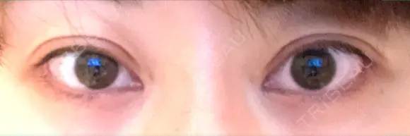 二重切開 / 目頭切開 / 目尻切開 / 下まぶたの脂肪取り 湘南美容クリニック 新宿本院 AFTER メイン用