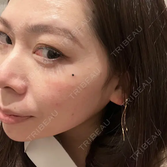 アートメイク（ほくろ） oneUPclinic DAY 0 メイン用