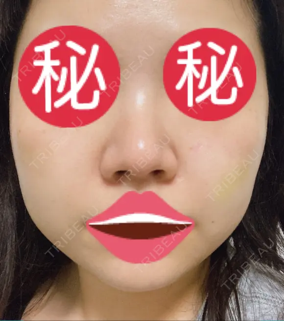 隆鼻術 / 鼻尖形成（切開） / 小鼻縮小（切開） / 軟骨移植 あいちビューティークリニック栄本院 DAY 49 メイン用