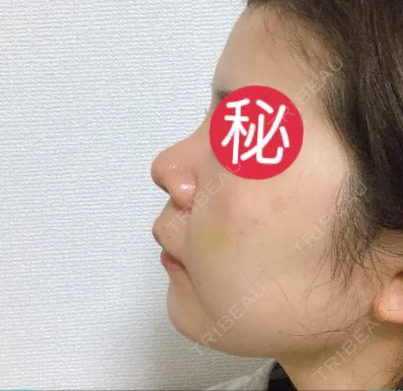 隆鼻術 / 鼻尖形成（切開） / 小鼻縮小（切開） / 軟骨移植 あいちビューティークリニック栄本院 DAY 49 メイン用