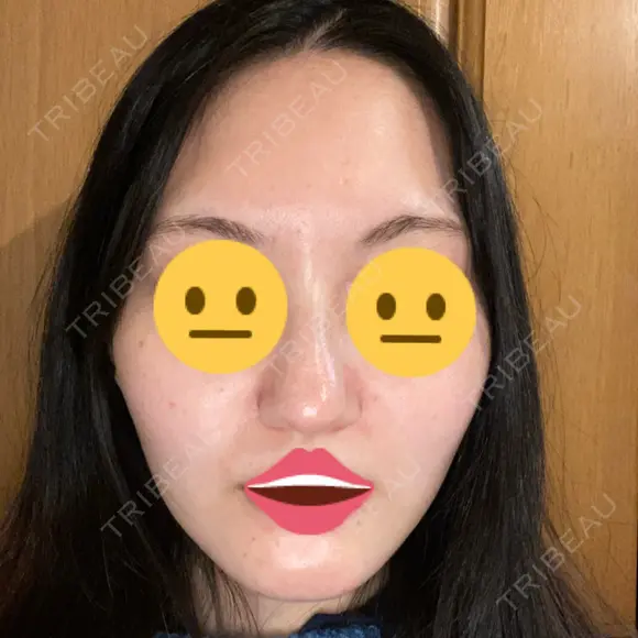 ピーリング（ニキビ・毛穴） 品川美容外科 福岡院 AFTER メイン用