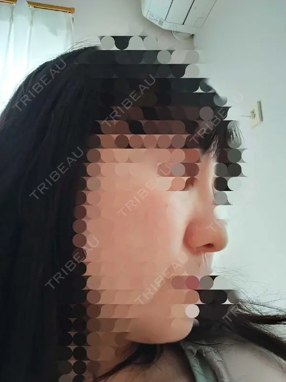 鼻尖形成（切開） / 鼻尖縮小 / ヒアルロン酸注入（鼻） 東京形成美容外科 船橋院 DAY 10 メイン用