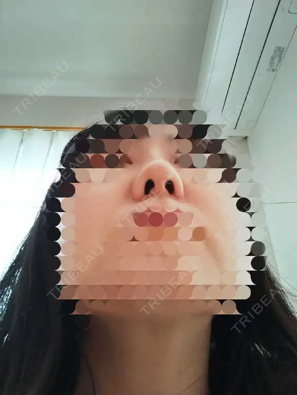 鼻尖形成（切開） / 鼻尖縮小 / ヒアルロン酸注入（鼻） 東京形成美容外科 船橋院 DAY 10 メイン用