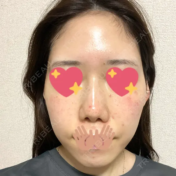 ヴェルヴェットスキン 表参道スキンクリニック 名古屋院（DAILY SKIN CLINIC提携院） DAY 0 メイン用