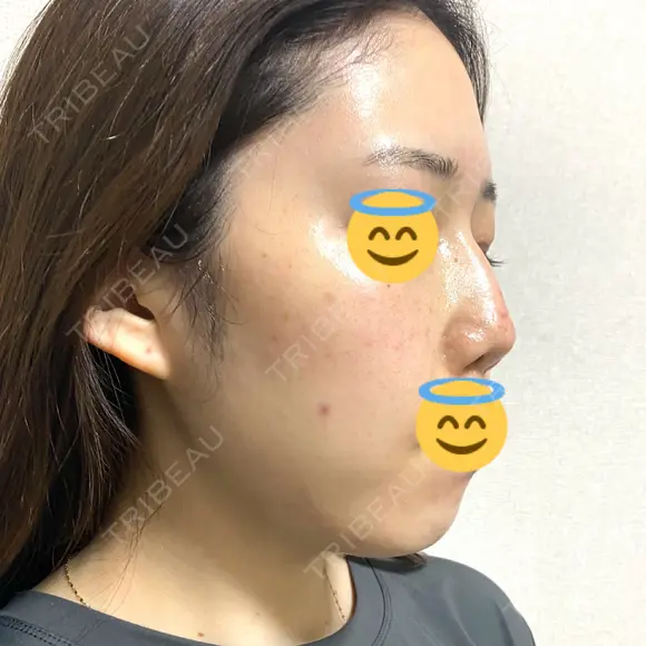 ヴェルヴェットスキン 表参道スキンクリニック 名古屋院（DAILY SKIN CLINIC提携院） DAY 0 メイン用