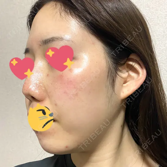 ヴェルヴェットスキン 表参道スキンクリニック 名古屋院（DAILY SKIN CLINIC提携院） DAY 0 メイン用