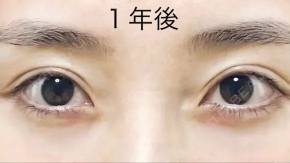 二重切開 / 上まぶたたるみ取り R.O.clinic AFTER メイン用