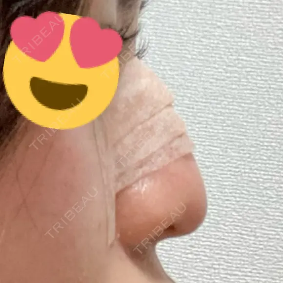 隆鼻術 / 軟骨移植 フェアクリニック川口 DAY 9 メイン用