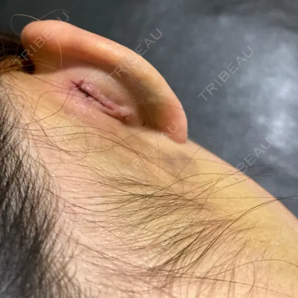 隆鼻術 / 軟骨移植 フェアクリニック川口 DAY 10 メイン用