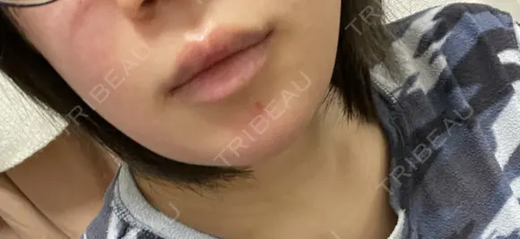 骨切り（あご） 銀座マイアミ美容外科 DAY 15 メイン用