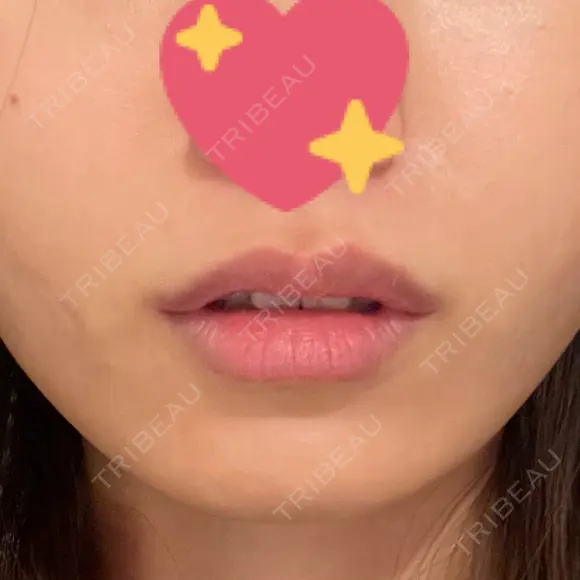 ヒアルロン酸注入（唇） ルラ美容クリニック 渋谷本院 AFTER メイン用