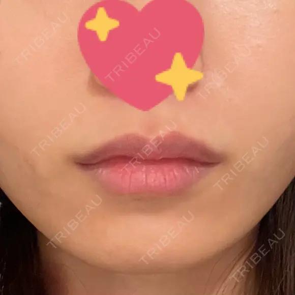 ヒアルロン酸注入（唇） ルラ美容クリニック 渋谷本院 DAY 20 メイン用