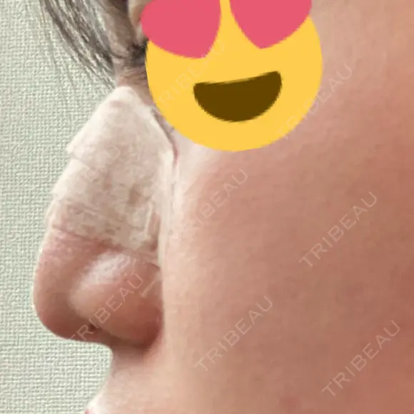 隆鼻術 / 軟骨移植 フェアクリニック川口 DAY 11 メイン用