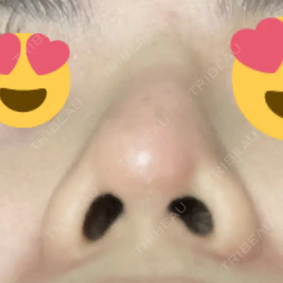 隆鼻術 / 軟骨移植 フェアクリニック川口 DAY 12 メイン用