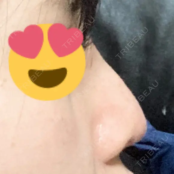 隆鼻術 / 軟骨移植 フェアクリニック川口 DAY 12 メイン用