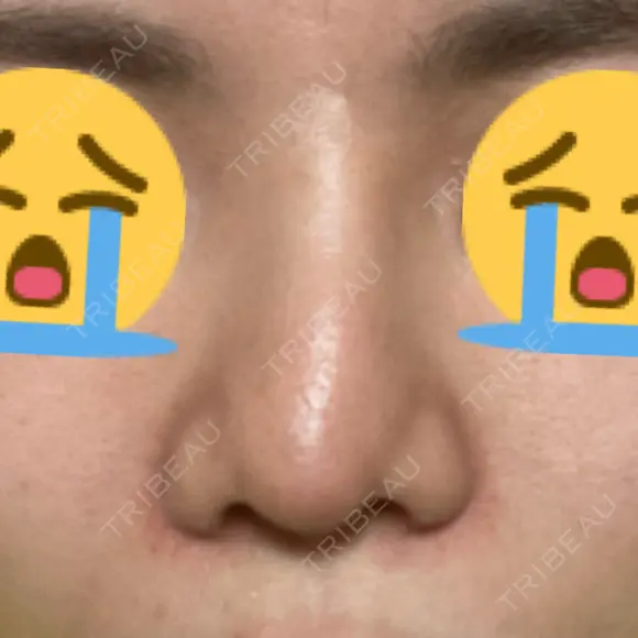 隆鼻術 / 軟骨移植 フェアクリニック川口 AFTER メイン用