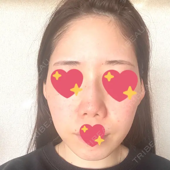 ヴェルヴェットスキン 表参道スキンクリニック 名古屋院（DAILY SKIN CLINIC提携院） DAY 3 メイン用