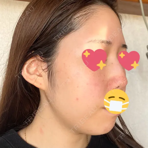 ヴェルヴェットスキン 表参道スキンクリニック 名古屋院（DAILY SKIN CLINIC提携院） DAY 3 メイン用