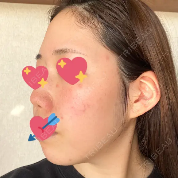 ヴェルヴェットスキン 表参道スキンクリニック 名古屋院（DAILY SKIN CLINIC提携院） DAY 3 メイン用