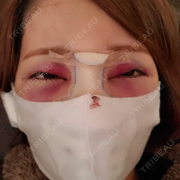 鼻尖形成（切開） / 鼻中隔延長（切開） / クマ治療 / 軟骨移植 R Beauty CLINIC 銀座院 DAY 1 メイン用
