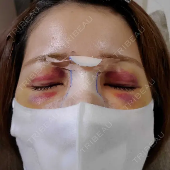 鼻尖形成（切開） / 鼻中隔延長（切開） / クマ治療 / 軟骨移植 R Beauty CLINIC 銀座院 DAY 4 メイン用