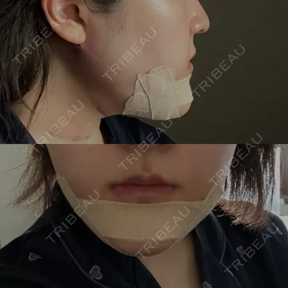 骨切り（あご） / 脂肪吸引（顔） / その他（輪郭） 銀座マイアミ美容外科 DAY 1 メイン用