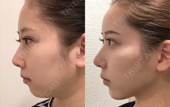 糸リフト / 脂肪吸引（顔） / ジョールファット除去 アリエル美容クリニック 大宮院 AFTER メイン用