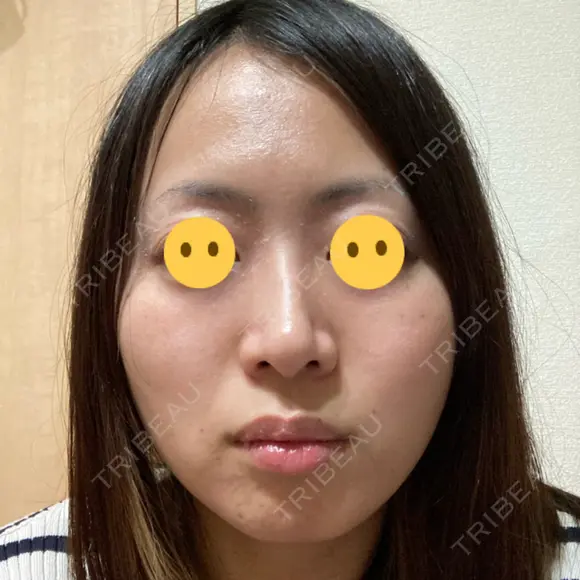 ヴェルヴェットスキン アリエル美容クリニック 大宮院 AFTER メイン用