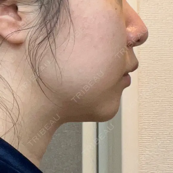 脂肪溶解注射（顔） 湘南美容クリニック 宇都宮院 DAY 21 メイン用