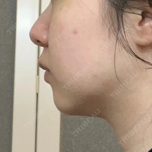 脂肪溶解注射（顔） 湘南美容クリニック 宇都宮院 DAY 21 メイン用