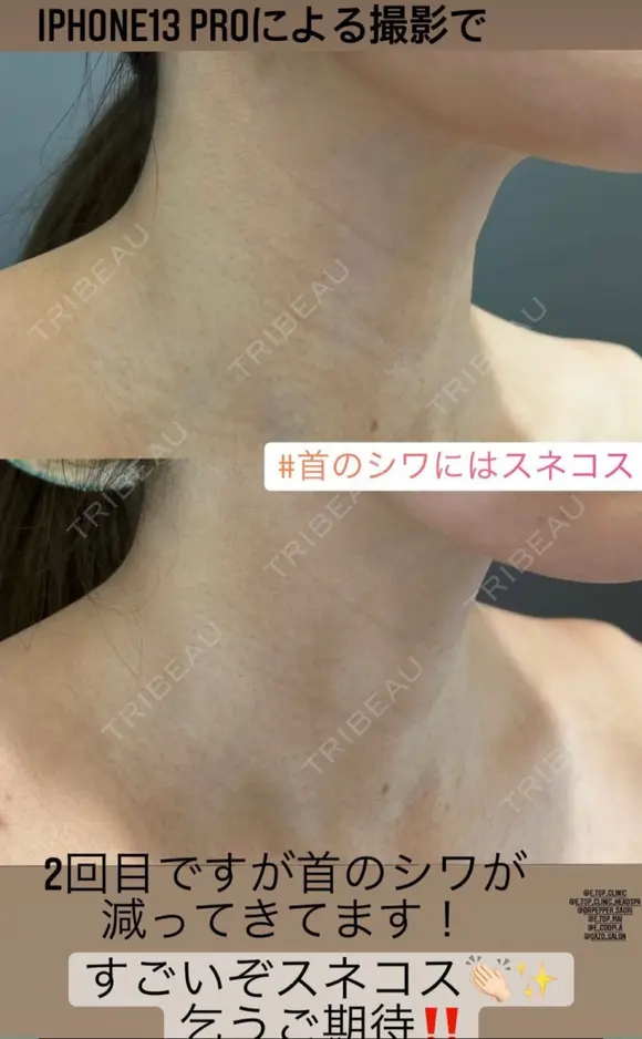 スネコス e:Top clinic（イートップクリニック） AFTER メイン用