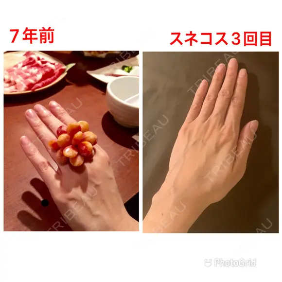 スネコス e:Top clinic（イートップクリニック） DAY 31 メイン用