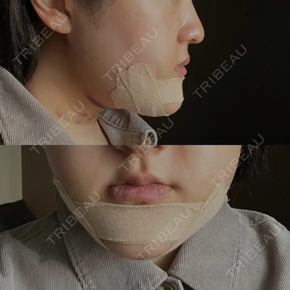 骨切り（あご） / 脂肪吸引（顔） / その他（輪郭） 銀座マイアミ美容外科 DAY 2 メイン用