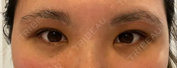 脂肪吸引（顔） / 上まぶたの脂肪取り / 下まぶたの脂肪取り / 眉下切開 LIKI CLINIC KOBE AFTER メイン用