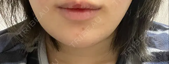 骨切り（あご） 銀座マイアミ美容外科 DAY 19 メイン用