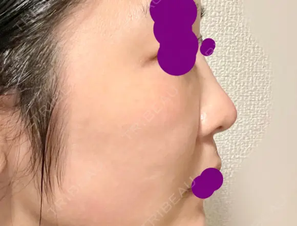 軟骨移植 フェアクリニック川口 AFTER メイン用