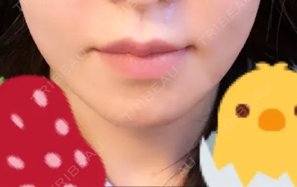 骨切り（あご） / 輪郭修正 / ボトックス（エラ・小顔） 心斎橋コムロ美容外科クリニック DAY 98 メイン用