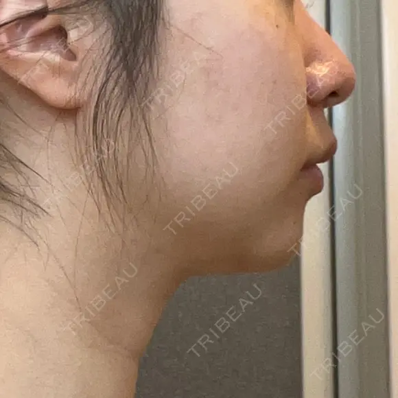 脂肪溶解注射（顔） 湘南美容クリニック 宇都宮院 DAY 24 メイン用