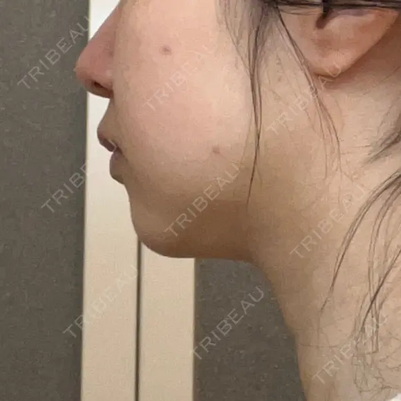 脂肪溶解注射（顔） 湘南美容クリニック 宇都宮院 DAY 24 メイン用