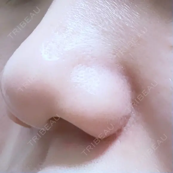 小鼻縮小（切開） ながしまクリニック DAY 293 メイン用