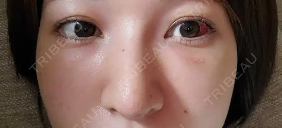 鼻尖形成（切開） / 鼻中隔延長（切開） / クマ治療 / 軟骨移植 R Beauty CLINIC 銀座院 DAY 10 メイン用