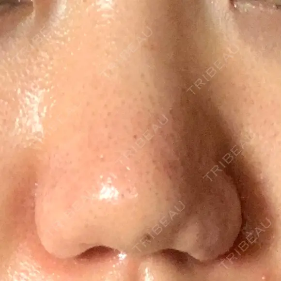 小鼻縮小（切開） / 鼻翼挙上 / 鼻孔縁挙上 くさのたろうクリニック AFTER メイン用