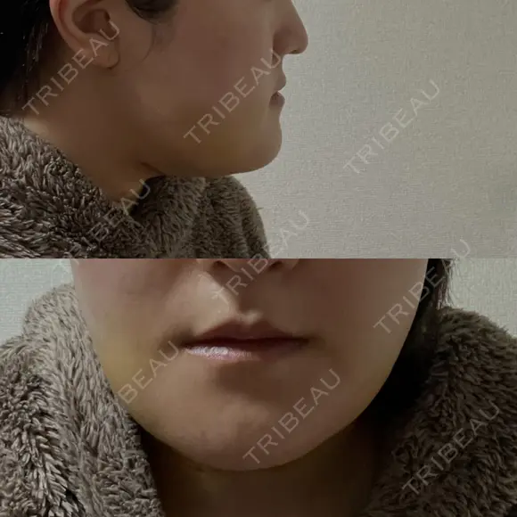 骨切り（あご） / 脂肪吸引（顔） / その他（輪郭） 銀座マイアミ美容外科 DAY 7 メイン用