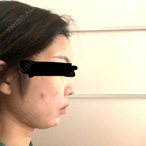 脂肪注入（肌） ヴェルトラクリニック 大阪院 AFTER メイン用