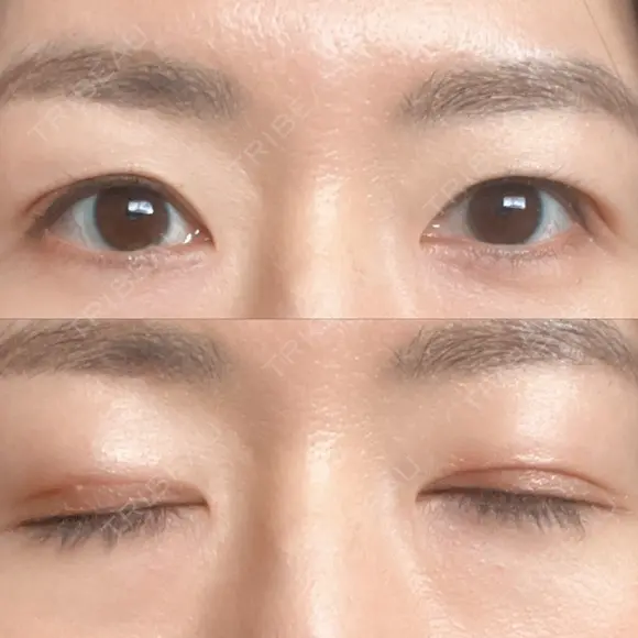 二重切開 城本クリニック 長崎院 DAY 136 メイン用