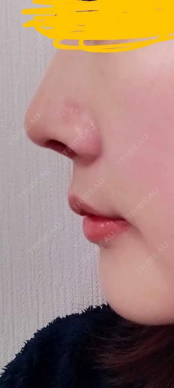 軟骨移植 LIKI CLINIC KOBE DAY 6 メイン用