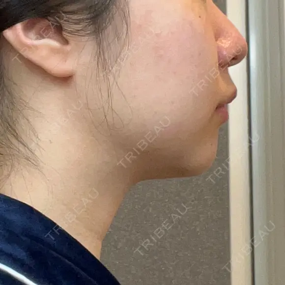 脂肪溶解注射（顔） 湘南美容クリニック 宇都宮院 DAY 30 メイン用
