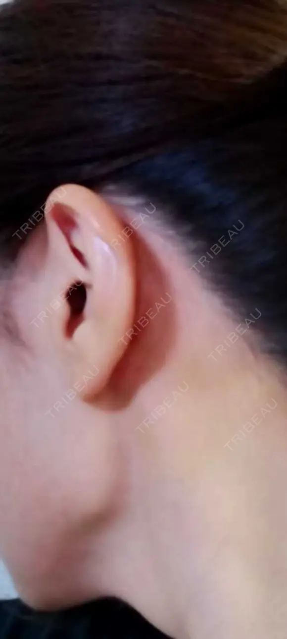 軟骨移植 LIKI CLINIC KOBE DAY 7 メイン用