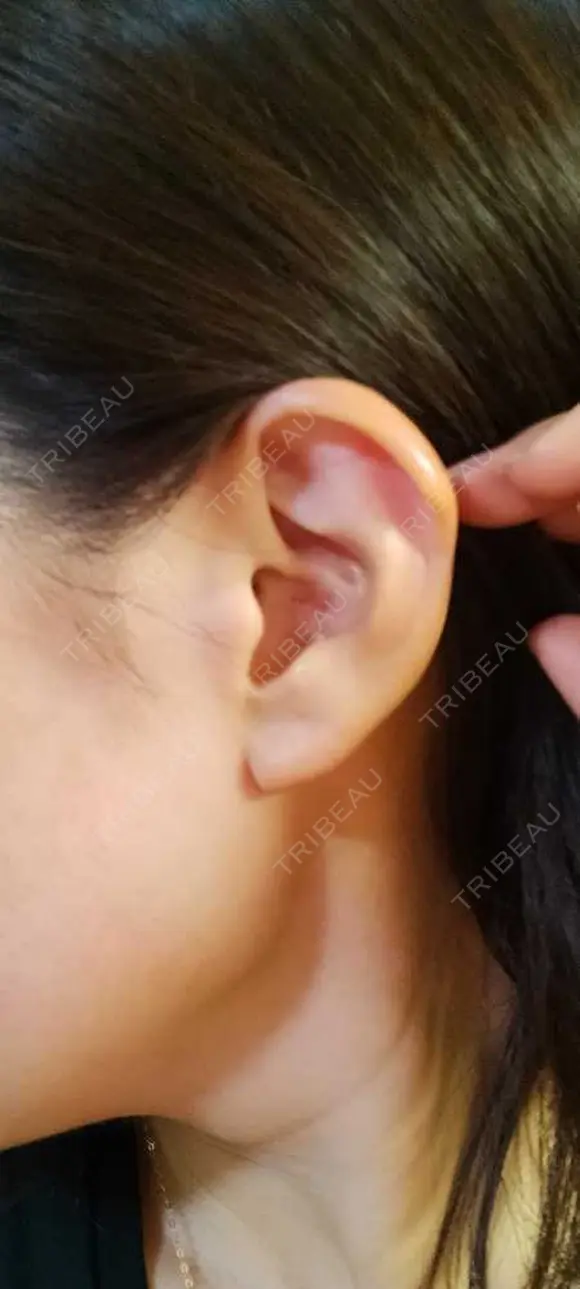 軟骨移植 LIKI CLINIC KOBE DAY 7 メイン用